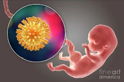 Персистенция  SARS-COV-2 в плаценте женщины на первом триместре беременности, приводящая к трансплацентарной  передаче вируса и гибели плода при бессимптомном течении болезни у матери 