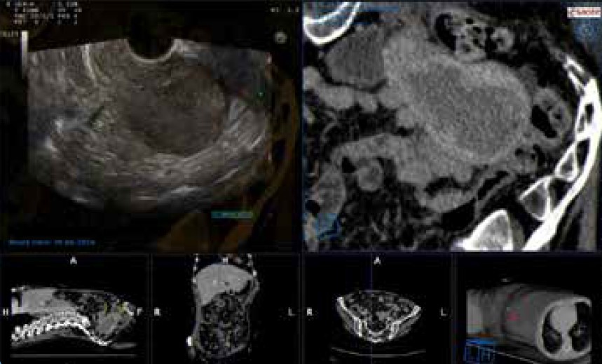 Роль fusion Imaging в гинекологической онкологии